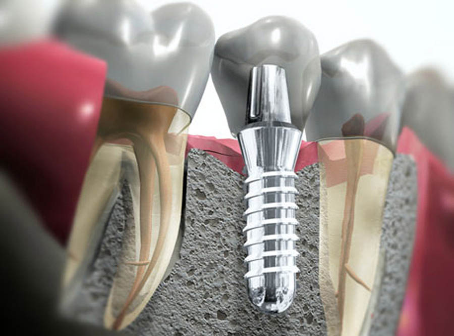 Имплантационная стоматология